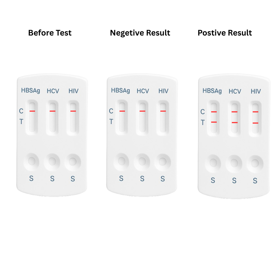 Three test card results: before, negative, and positive with HBsAg, HCV, HIV markers